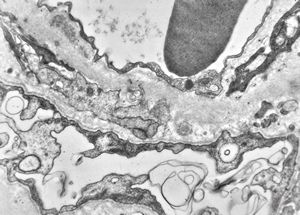 F,16y. | type III membranoproliferative glomerulonephritis